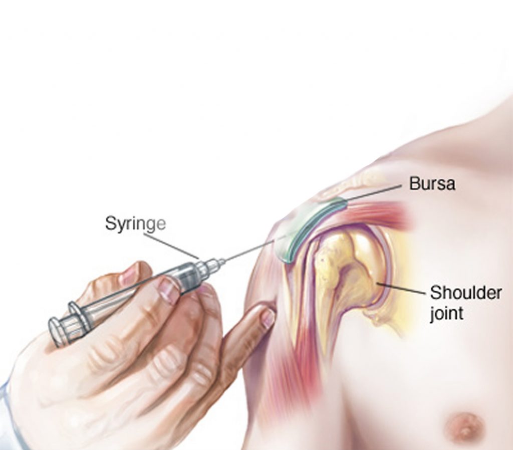 Steroid Injection Finger Steroid Injections Benefits in Norfolk | Effective Pain Relief